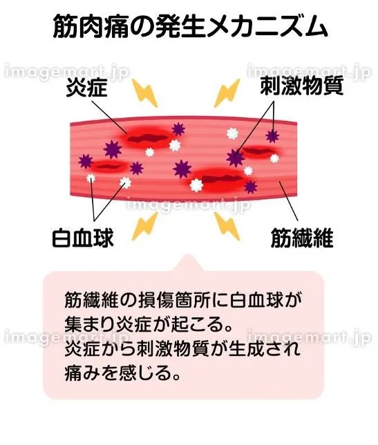 💪我慢しないで!!筋肉痛😖